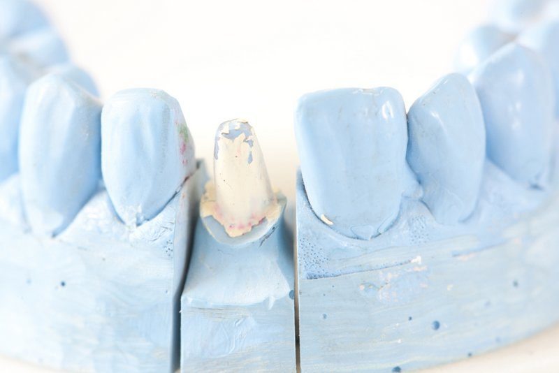 Kronen, Brücken, Implantate - was deckt Ihre Zahnzusatzversicherung? (© Herby Me / Fotolia)